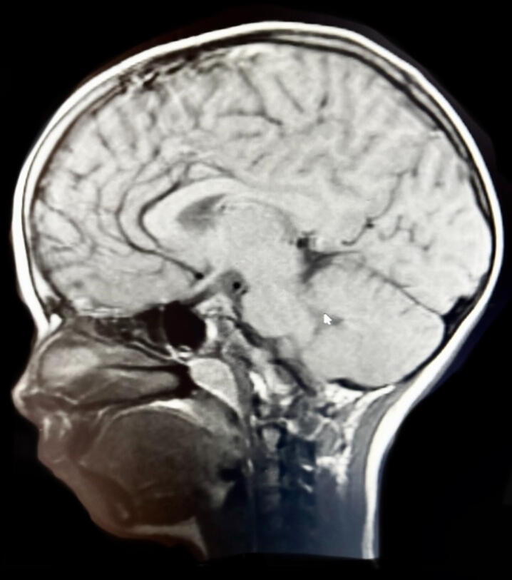 Frankenstein Vs. Hunchback