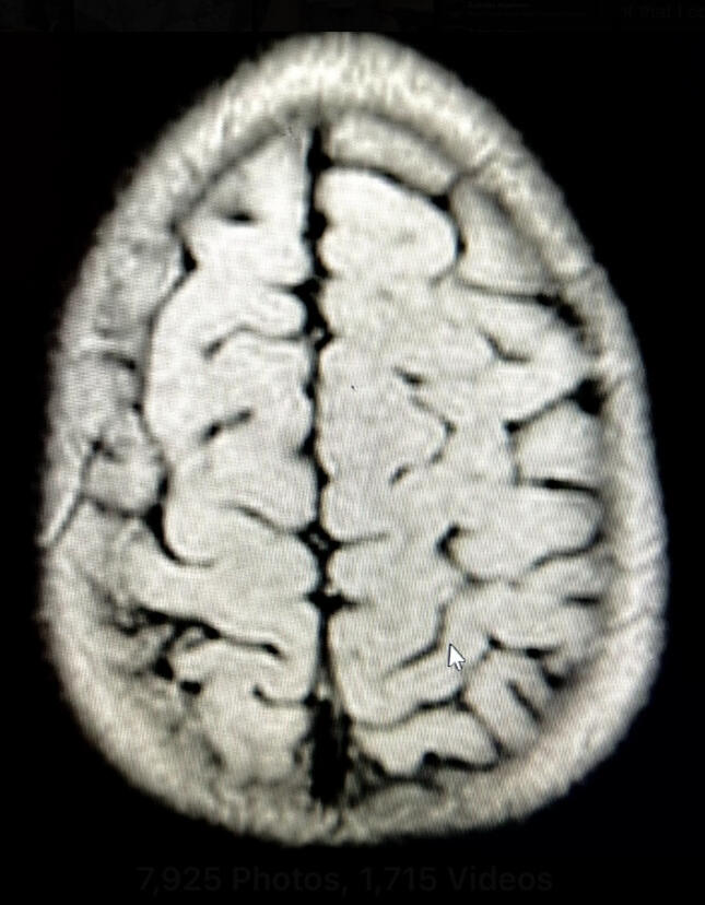 1818 VS. 1823 DIFFERENCES